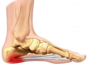 plantar-fascia Plantar Fasciitis Pain