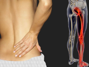 sciatica-pain-treatmentand Sciatica Pain Treatment
